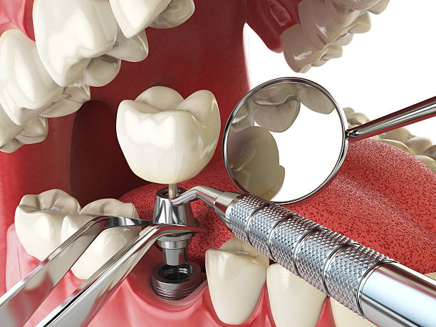 Best Emergency Root Canal Therapy in Ladera Ranch, CA